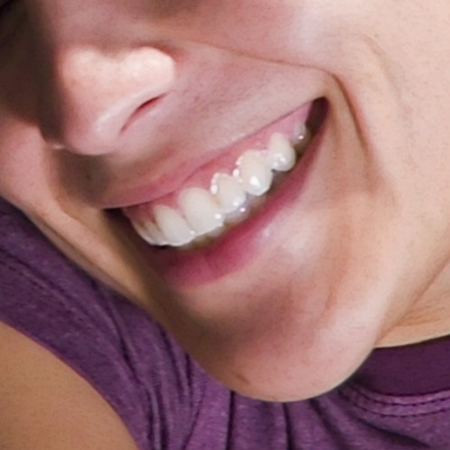 Implantes Dentários: como fazer a escolha certa?